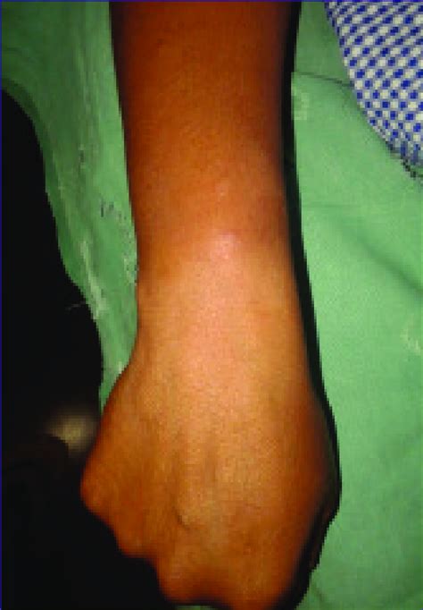 Clinical Photograph Of The Patient Showing A Swelling On The Dorsum Of