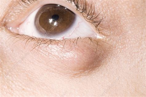Chalazion Cyst On An Eyelid Stock Image M1550609 Science Photo