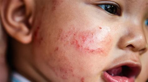 Những điều Cần Biết Về Eczema ở Trẻ Em Viam Clinic