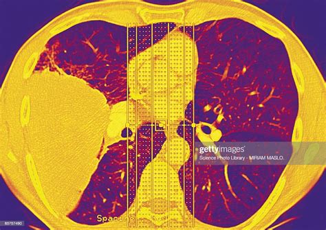 Lung Cancer High Res Stock Photo Getty Images