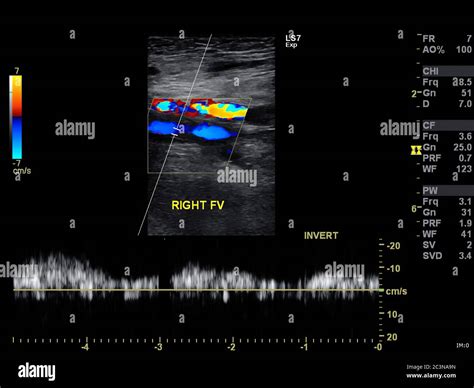 A Doppler Ultrasound Image Is A Noninvasive Test That Can Be Used To