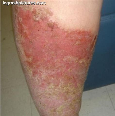 Allergic Skin Rash Skin Rash Pinterest