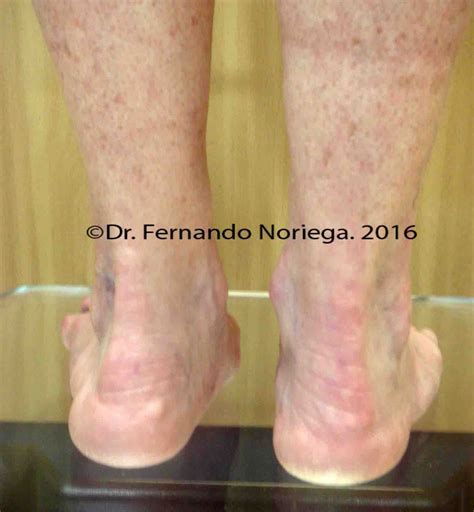 Artritis Reumatoide Archives El Blog Del Dr Fernando Noriegael Blog