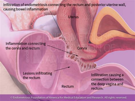 Endometriosis Symptoms Gastrointestinal Distress Endofound