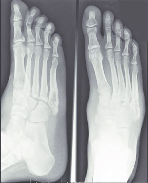 List 94 Images Normal X Ray Of Foot And Ankle Sharp