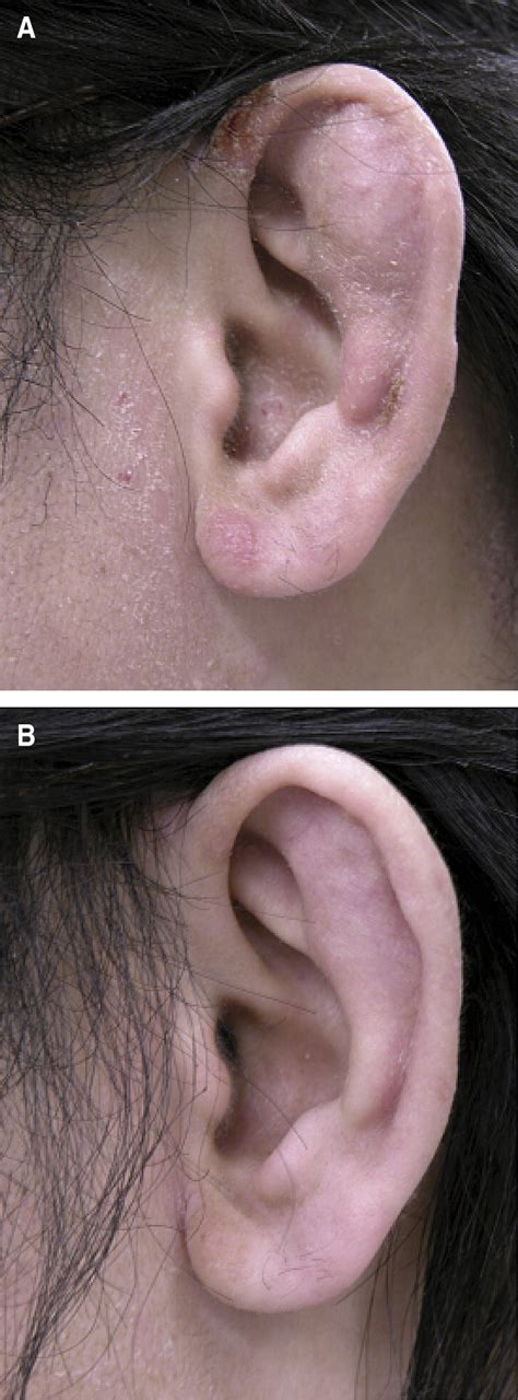 Pseudocysts Of The Auricle In A Young Adult With Facial And Ear Atopic