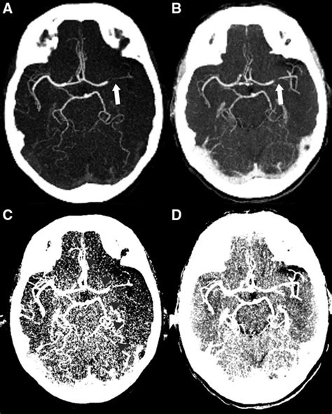 Computed Tomography Angiography In Hyperacute Ischemic Stroke Stroke