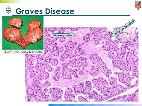 Pathology of Endocrine Disorders
