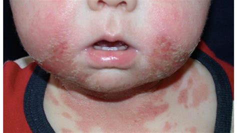 Types Of Rashes On Baby Skin Better Health Channel