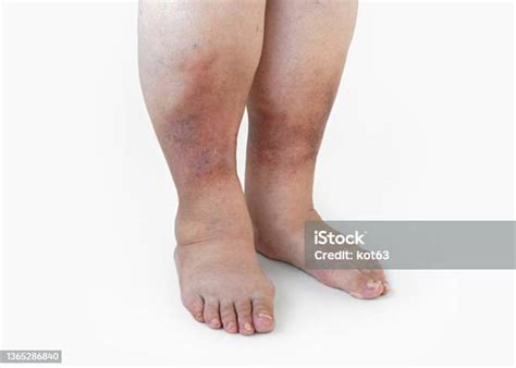 Inflamed Legs Of A Woman With Diabetes Closeup Stock Photo Download