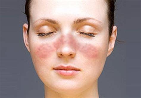 Dermatology Pictures Of Common Skin Rashes Medhelp