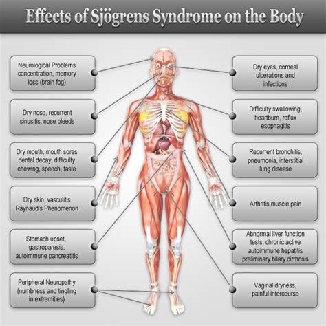 Pin By Sixpence On Sjogrens And Lupus Disease Sjogrens Autoimmune