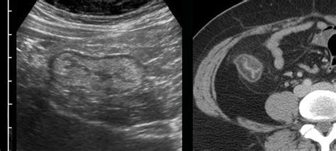 The Radiology Assistant Crohns Disease Role Of Ultrasound