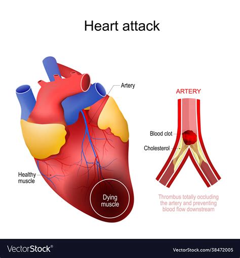Heart Attack Myocardial Infarction