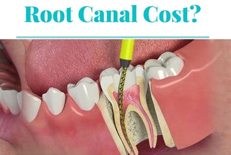 Dental crowns, dentures, and dental implants are major procedures that. Frugal Finance: How To Pay Less For A Root Canal