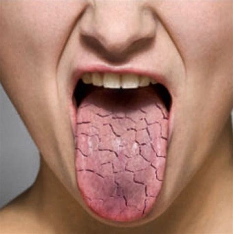 Slina zásadním způsobem ovlivňuje prostředí dutiny ústní, vnímání pocitu žízně a celkový komfort úst. Xerostomie | syndroom van Sjögren drogemondklachten ...