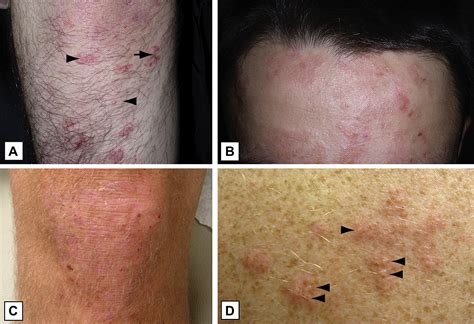 Dermatitis Herpetiformis Journal Of The American Academy Of Dermatology