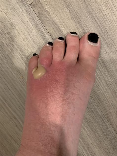 Cellulitis Day 7 Rpopping