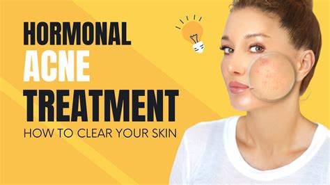 Hormonal Acne Treatment How To Clear Your Skin Youtube