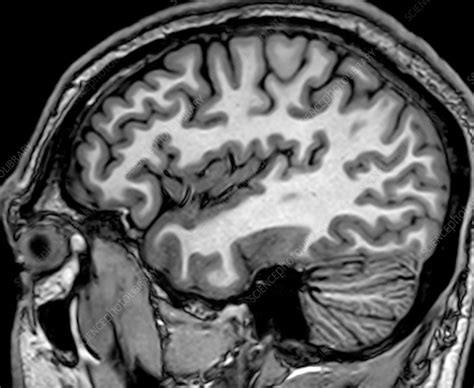 Normal Sagittal Brain Mri