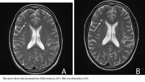 Figure 1 33 Year Young Women With Systemic Lupus Erythematosus Mri