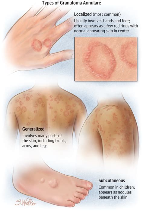 Granuloma Annulare Allergy And Clinical Immunology Jama Dermatology