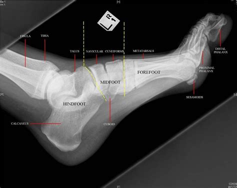 foot x ray anatomy