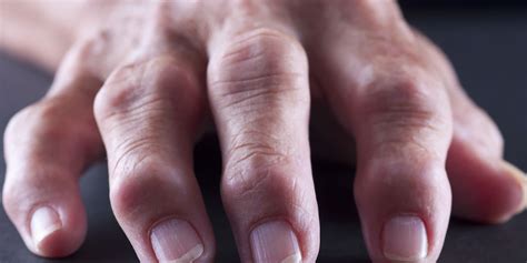 Doctors Explain All The Reasons You May Be Dealing With Swollen Fingers