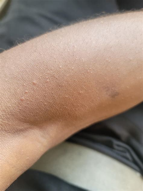 Could These Bumps On My Arm Be Related To An Allergic Reaction No Know