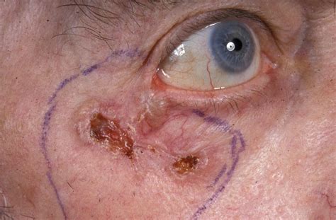 Skin Cancer Lesions On Face