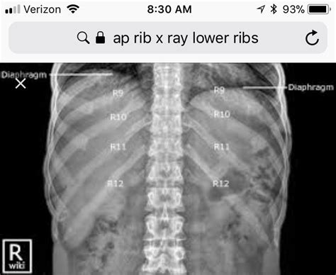Ap Lower Ribs Used To Visualize Posterior Ribs Learning To Be