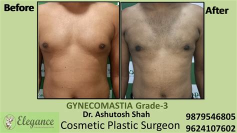 Gynecomastia Grade 3 Slight Breast Roll Surgery Valsad Gujarat India