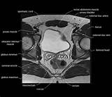 Muscles of the pelvis that cross the lumbosacral joint to attach onto the trunk were described in the previous blog post note: MRI pelvis anatomy | free male pelvis axial anatomy ...