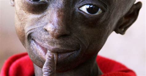 Progeria First Black Child With Rare Aging Disease Photo 1