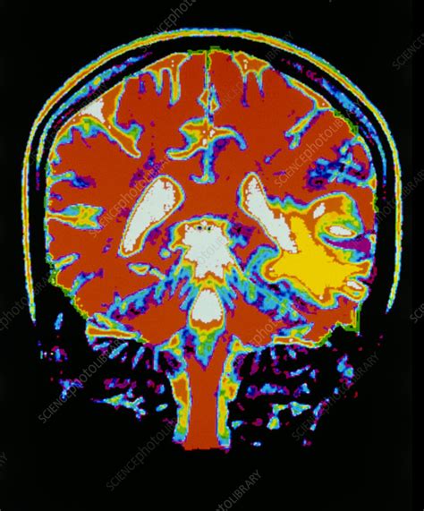 Mri Scan Of The Brain After A Stroke Stock Image M1360077