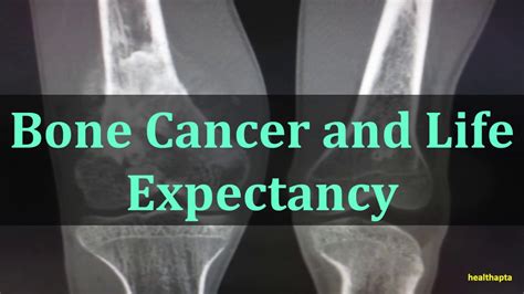 Bone Cancer And Life Expectancy Youtube