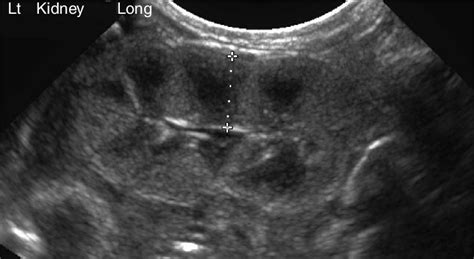 Neonatal Kidney Ultrasound Sagittal Ultrasound Image Of A Preterm