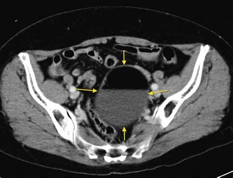 Ovarian Dermoid Radiology At St Vincents University Hospital