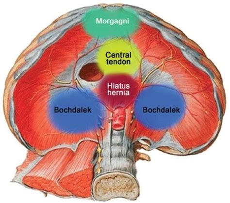 Congenital Diaphragmatic Hernia The Operative Review Of Surgery