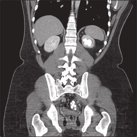 Ct Scan Of Abdomen Showing Multiple Stones In The Left Kidney And Lower