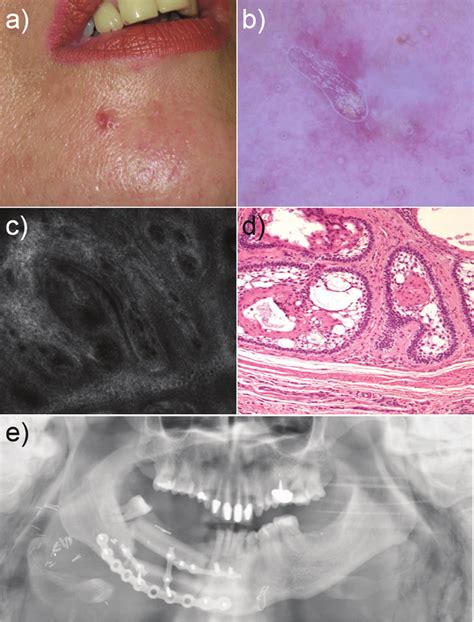 Clinical A And Dermoscopic Image B Of The Nodule Showing Small