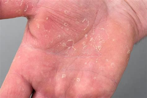 Dry Man`s Hand With Skin Peeling Off Eczema Dermatitis Stock Photo