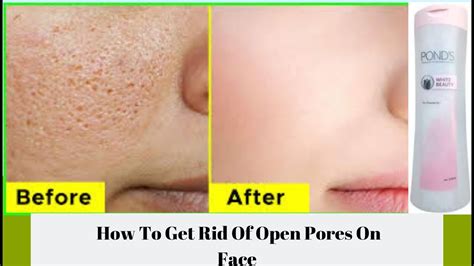 How To Get Rid Of Open Pores On Face Youtube