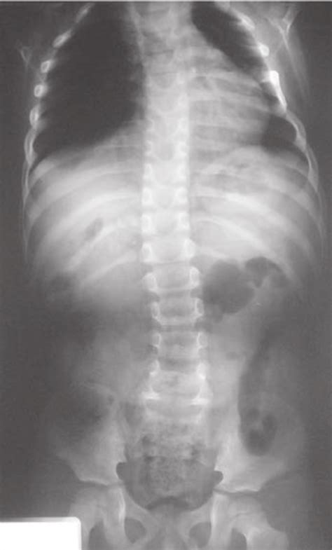 Lumbar X Ray Showed Mild Scoliosis Spina Bifida Occulta On The 5 Th