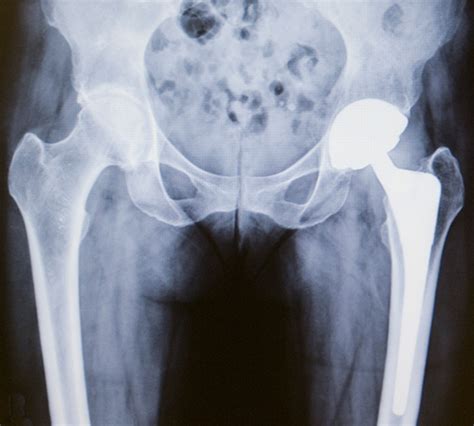 total hip replacement recovery stories ridgel clement