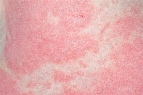 Urticaria Stock Image C0269183 Science Photo Library