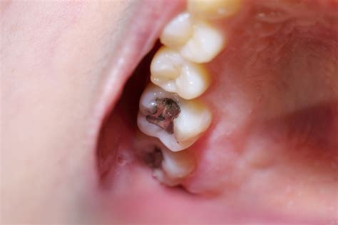 Old Dental Filling Fell Out Heres What To Do