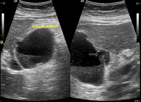 Perforated Gallbladder Ultrasound