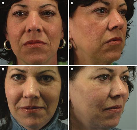 Thread Lift For Facial Rejuvenation Jama Facial Plastic Surgery The