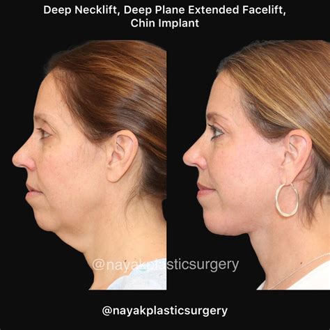 Before And After Deep Necklift Procedures In St Louis Mo Nayak